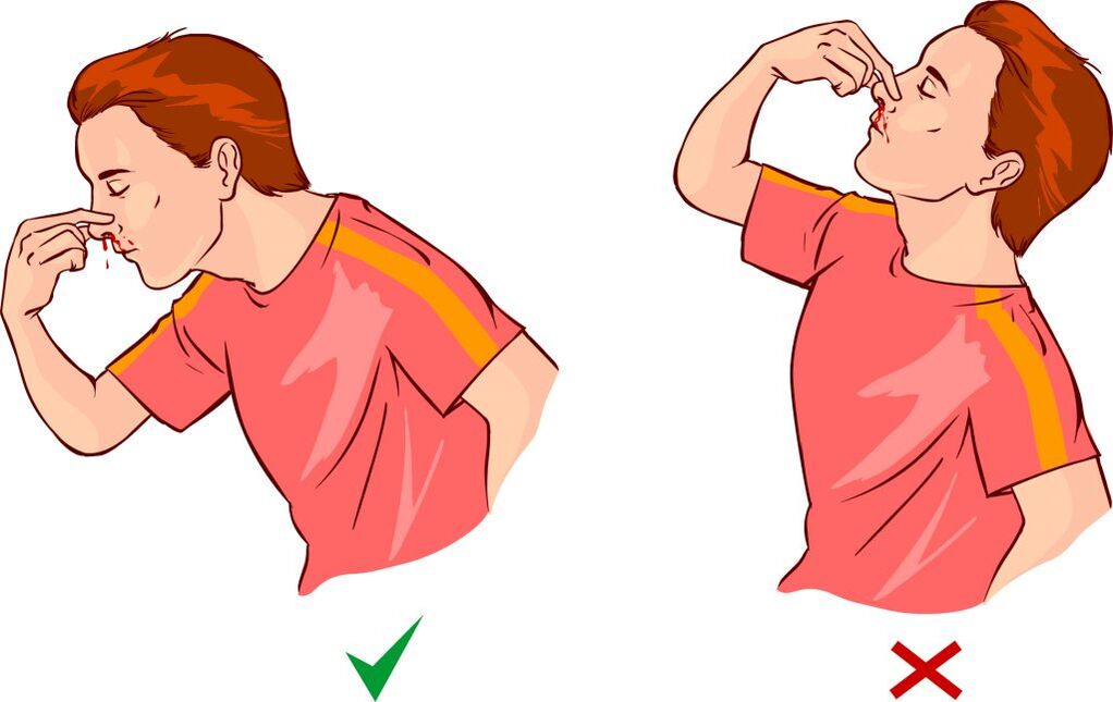 Epistaxis für Bluthochdruck